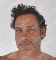 After hair transplant After hair transplant