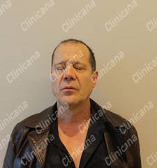 Before hair transplant Before hair transplant
