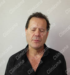 After hair transplant After hair transplant