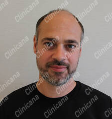 Before hair transplant Before hair transplant