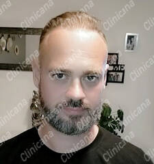 After hair transplant After hair transplant