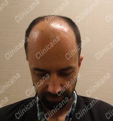 Before hair transplant Before hair transplant