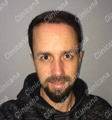 After hair transplant After hair transplant