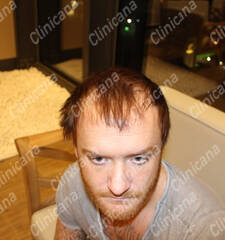 Before hair transplant Before hair transplant