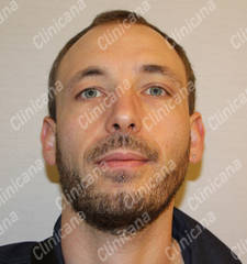 Before hair transplant Before hair transplant