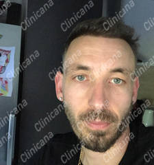 After hair transplant After hair transplant