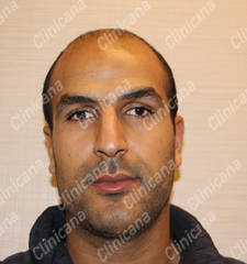 Before hair transplant Before hair transplant