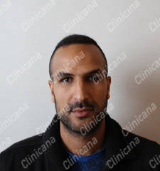 After hair transplant After hair transplant