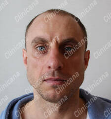 Before hair transplant Before hair transplant