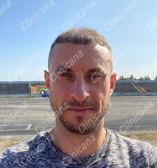 After hair transplant After hair transplant