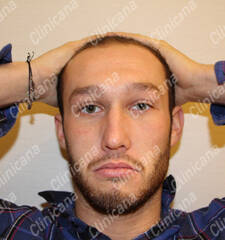 Before hair transplant Before hair transplant