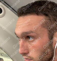 After hair transplant After hair transplant