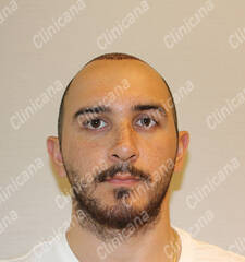 Before hair transplant Before hair transplant