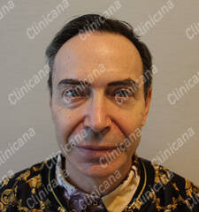 Before hair transplant Before hair transplant