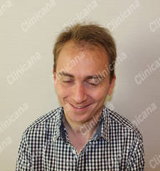 Before hair transplant Before hair transplant