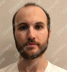 Before hair transplant Before hair transplant