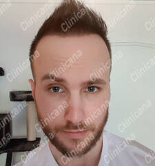 After hair transplant After hair transplant