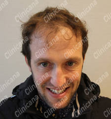 Before hair transplant Before hair transplant