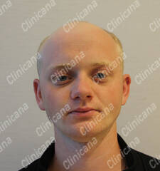 Before hair transplant Before hair transplant