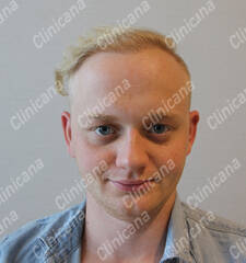 After hair transplant After hair transplant