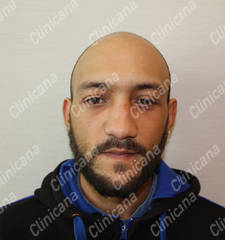 Before hair transplant Before hair transplant