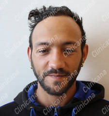 After hair transplant After hair transplant