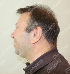 Before hair transplant Before hair transplant