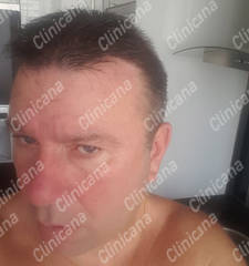 After hair transplant After hair transplant