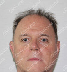 Before hair transplant Before hair transplant