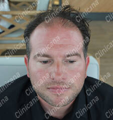 Before hair transplant Before hair transplant