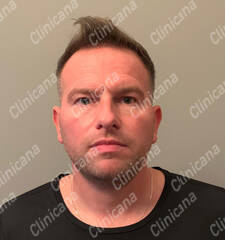 After hair transplant After hair transplant