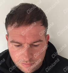 After hair transplant After hair transplant