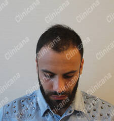 Before hair transplant Before hair transplant