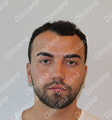 Before hair transplant Before hair transplant