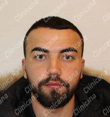 After hair transplant After hair transplant