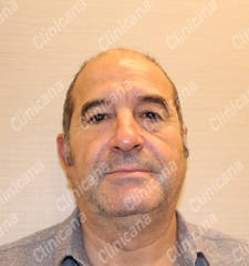 Before hair transplant Before hair transplant