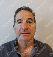 After hair transplant After hair transplant