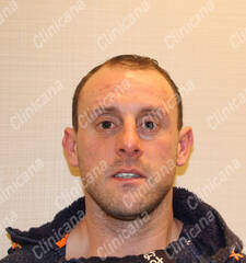 Before hair transplant Before hair transplant