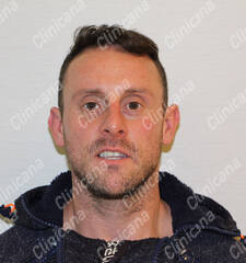 After hair transplant After hair transplant