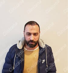 After hair transplant After hair transplant