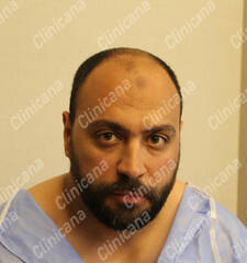 Before hair transplant Before hair transplant