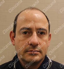 Before hair transplant Before hair transplant