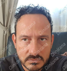 After hair transplant After hair transplant
