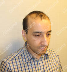 Before hair transplant Before hair transplant