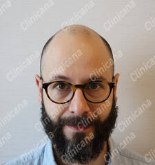 Before hair transplant Before hair transplant