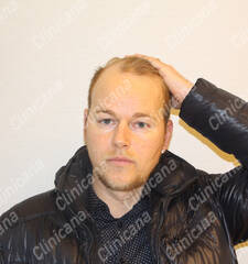 Before hair transplant Before hair transplant
