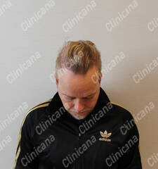 After hair transplant After hair transplant