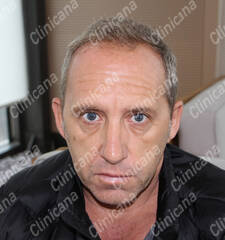 Before hair transplant Before hair transplant