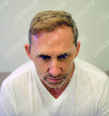 After hair transplant After hair transplant