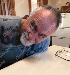 Before hair transplant Before hair transplant